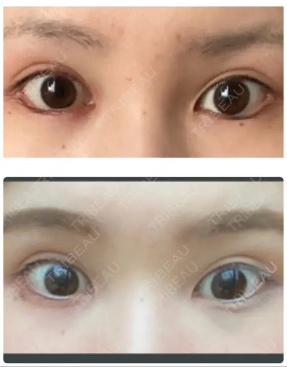 目尻切開 / タレ目形成・グラマラスライン（切開） ビスポーククリニック 福岡院 DAY 34 メイン用