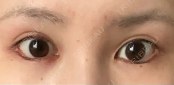 目尻切開 / タレ目形成・グラマラスライン（切開） ビスポーククリニック 福岡院 DAY 34 メイン用