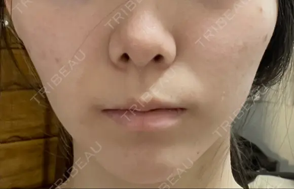 脂肪吸引（顔） Mods Clinic（モッズクリニック） 東京院 DAY 20 メイン用