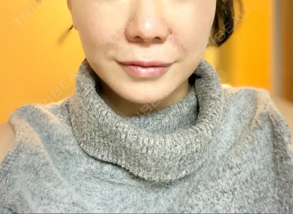 切開リフト / ボトックス（エラ・小顔） 石倉クリニック 水戸院 DAY 28 メイン用