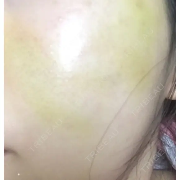 糸リフト ニューセンス皮膚科クリニック DAY 12 メイン用
