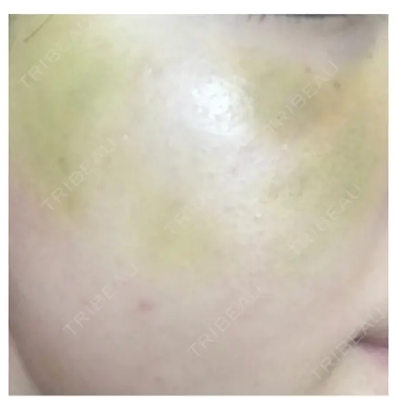 糸リフト ニューセンス皮膚科クリニック DAY 15 メイン用
