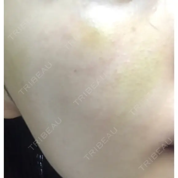 糸リフト ニューセンス皮膚科クリニック DAY 45 メイン用