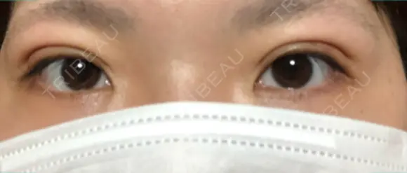 二重埋没 こうべ花時計クリニック DAY 10 メイン用