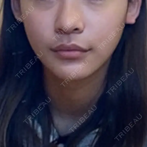 糸リフト / 骨切り（あご） / 脂肪吸引（顔） / ボトックス（エラ・小顔） 銀座マイアミ美容外科 DAY 19 メイン用