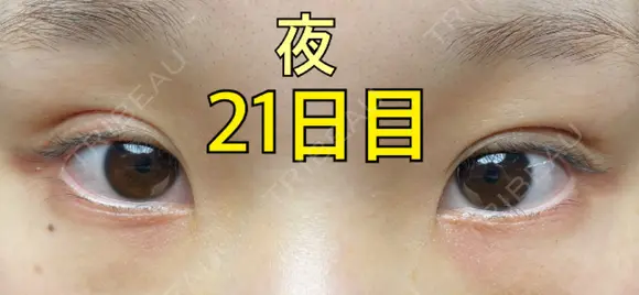 二重埋没 ながしまクリニック DAY 21 メイン用