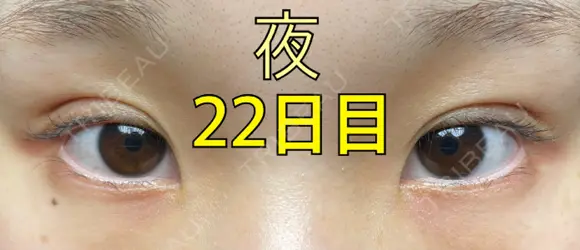 二重埋没 ながしまクリニック DAY 22 メイン用