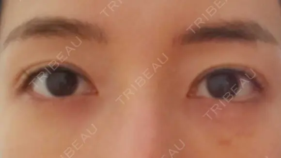 クマ治療 APOLLO BEAUTY CLINIC DAY 8 メイン用