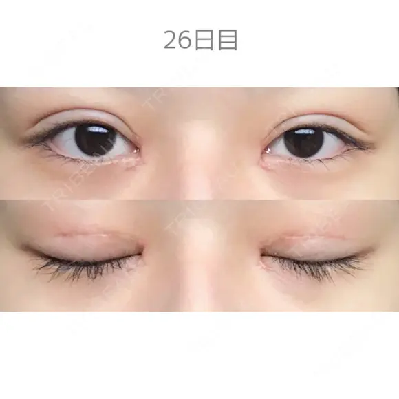 二重切開 / 目頭切開 / 上まぶたたるみ取り サラ美容外科 DAY 26 メイン用