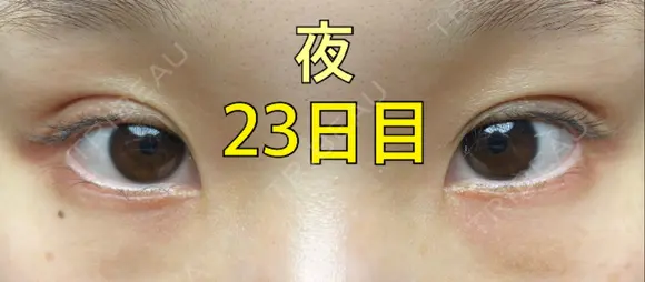 二重埋没 ながしまクリニック DAY 23 メイン用