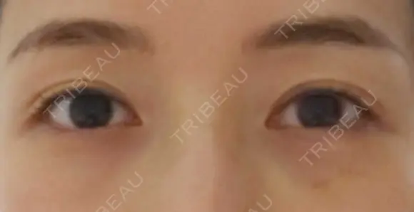 クマ治療 APOLLO BEAUTY CLINIC DAY 8 メイン用