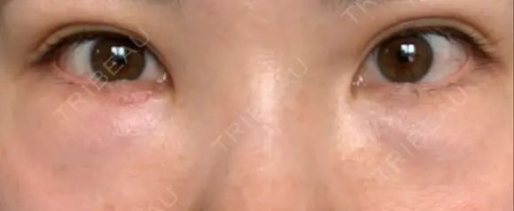 下まぶたの脂肪取り 品川美容外科 仙台院 DAY 1 メイン用