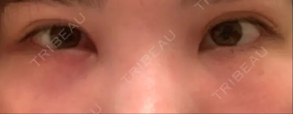 下まぶたの脂肪取り 品川美容外科 仙台院 DAY 2 メイン用