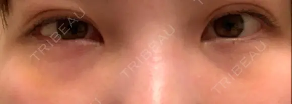 下まぶたの脂肪取り 品川美容外科 仙台院 DAY 3 メイン用