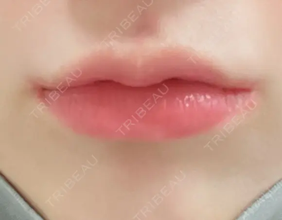 口唇縮小術 / 口角挙上 B-LINE CLINIC 池袋院 DAY 91 メイン用