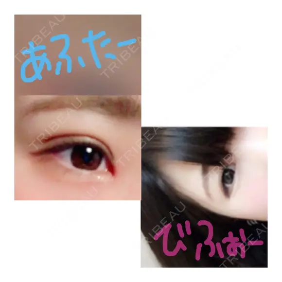 二重埋没 / 目頭切開 かめい美容クリニック宇都宮 DAY 9 メイン用