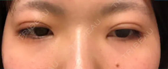 二重埋没 こうべ花時計クリニック DAY 14 メイン用