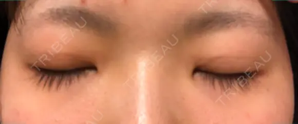 二重埋没 こうべ花時計クリニック DAY 14 メイン用