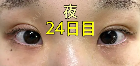 二重埋没 ながしまクリニック DAY 24 メイン用