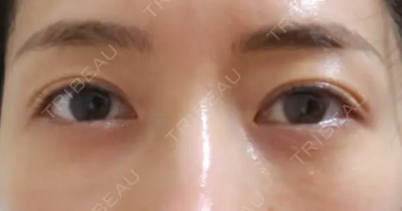 クマ治療 APOLLO BEAUTY CLINIC DAY 9 メイン用