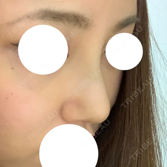 鼻尖形成（切開） / 軟骨移植 / 眉間プロテーゼ 湘南美容クリニック 神戸院 DAY 8 メイン用