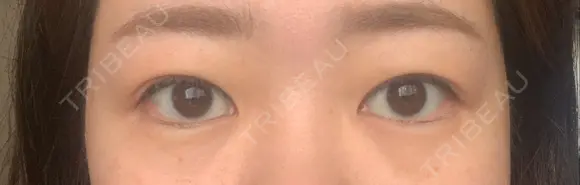 二重埋没 ハナキクリニック AFTER メイン用