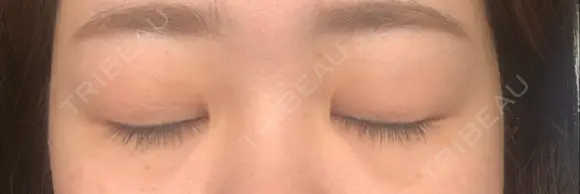 二重埋没 ハナキクリニック DAY 47 メイン用
