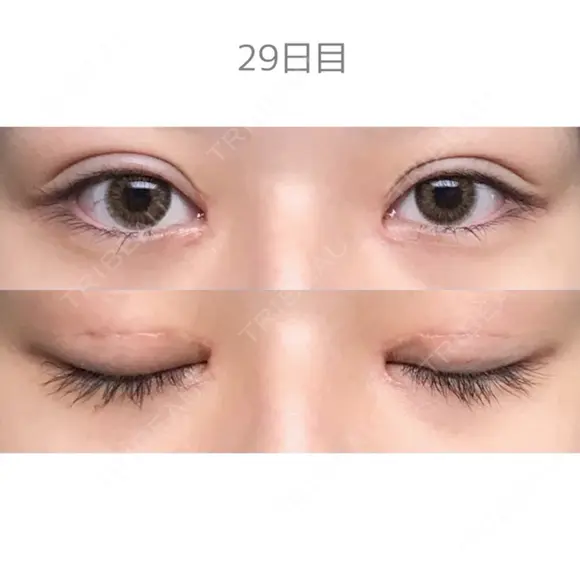 二重切開 / 目頭切開 / 上まぶたたるみ取り サラ美容外科 DAY 27 メイン用