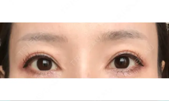 アートメイク（眉） GRACIA clinic 【グラシアクリニック】 DAY 101 メイン用