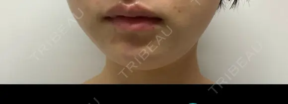 脂肪溶解注射（顔） TCB東京中央美容外科 千葉駅前院 AFTER メイン用