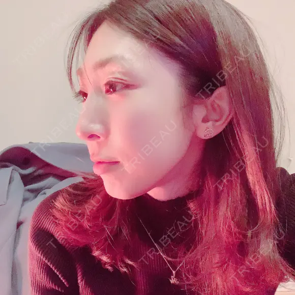 骨切り（あご） / 骨削り（エラ） / 骨削り（頬） / 脂肪注入（輪郭） バノバギ整形外科 AFTER メイン用