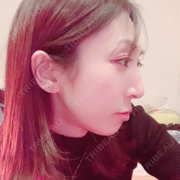 骨切り（あご） / 骨削り（エラ） / 骨削り（頬） / 脂肪注入（輪郭） バノバギ整形外科 DAY 365 メイン用