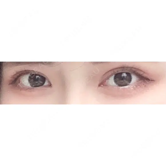 二重切開 / 目頭切開 東京イセアクリニック DAY 85 メイン用