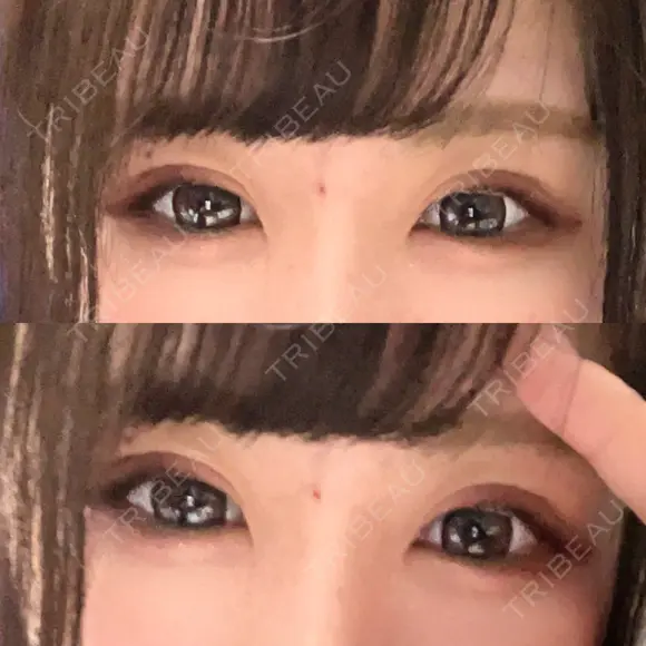 二重埋没 / ヒアルロン酸注入（涙袋） ルラ美容クリニック 新宿院 DAY 105 メイン用