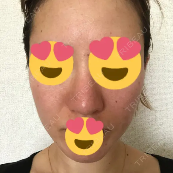 ピーリング（ニキビ・毛穴） / ダーマペン 表参道スキンクリニック 名古屋院（DAILY SKIN CLINIC提携院） DAY 2 メイン用