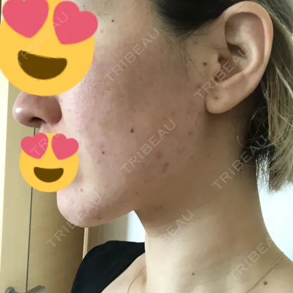 ピーリング（ニキビ・毛穴） / ダーマペン 表参道スキンクリニック 名古屋院（DAILY SKIN CLINIC提携院） DAY 2 メイン用