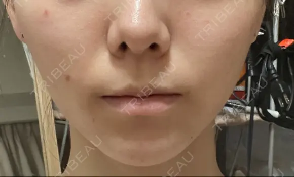 脂肪吸引（顔） Mods Clinic（モッズクリニック） 東京院 DAY 30 メイン用