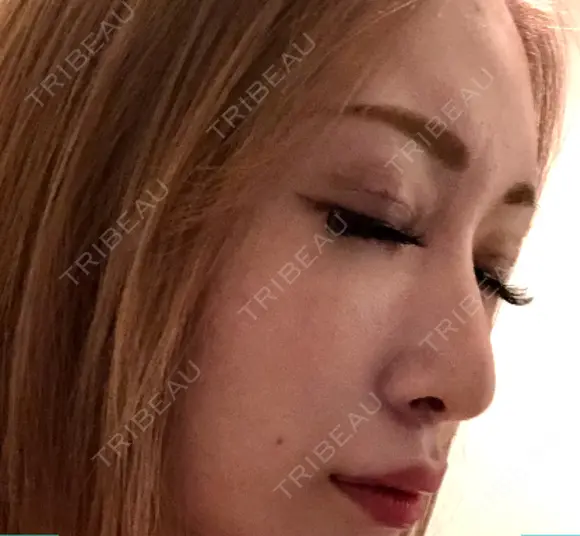 鼻尖形成（切開） 銀座マイアミ美容外科 DAY 15 メイン用