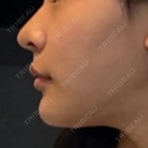 糸リフト / 骨切り（あご） / 脂肪吸引（顔） / ボトックス（エラ・小顔） 銀座マイアミ美容外科 DAY 28 メイン用