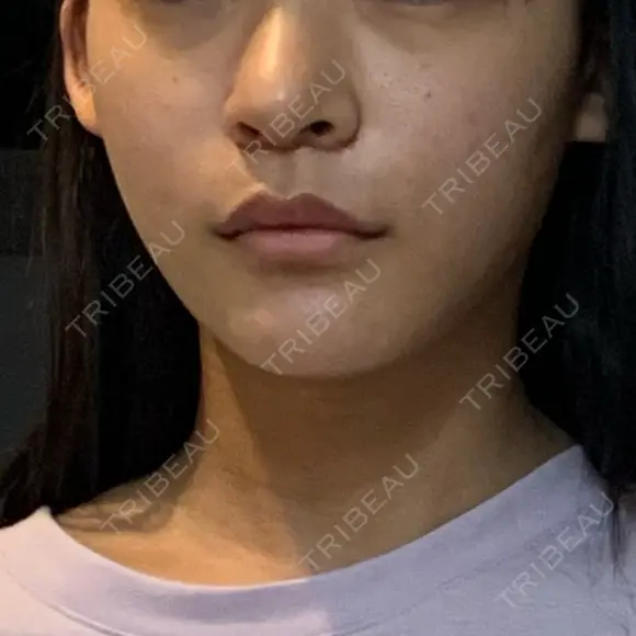 糸リフト / 骨切り（あご） / 脂肪吸引（顔） / ボトックス（エラ・小顔） 銀座マイアミ美容外科 DAY 28 メイン用