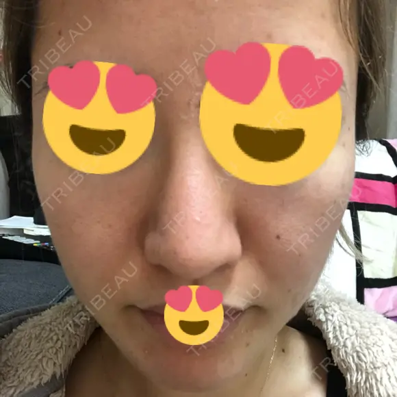 ピーリング（ニキビ・毛穴） / ダーマペン 表参道スキンクリニック 名古屋院（DAILY SKIN CLINIC提携院） DAY 4 メイン用