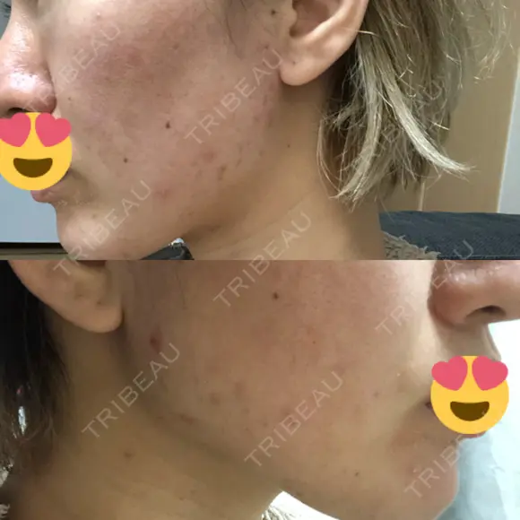 ピーリング（ニキビ・毛穴） / ダーマペン 表参道スキンクリニック 名古屋院（DAILY SKIN CLINIC提携院） DAY 4 メイン用