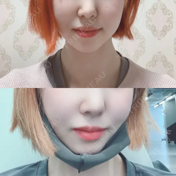 骨切り（あご） / 骨削り（エラ） / 骨削り（頬） id（アイディ）美容外科 AFTER メイン用