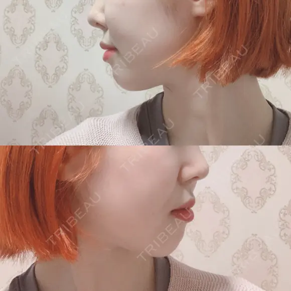 骨切り（あご） / 骨削り（エラ） / 骨削り（頬） id（アイディ）美容外科 DAY 362 メイン用