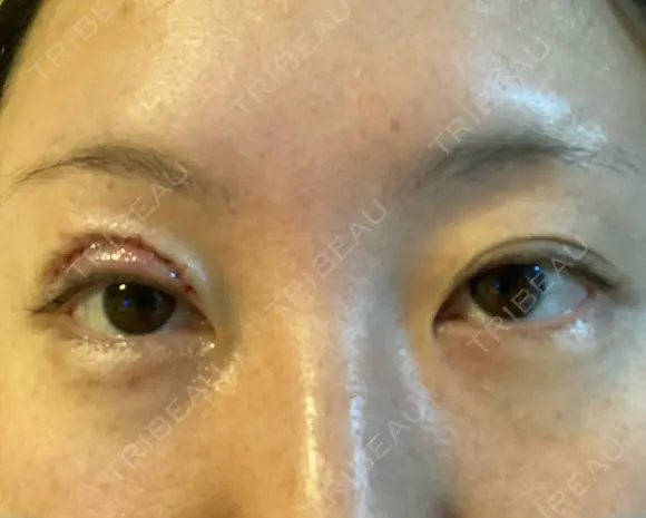 眼瞼下垂（切開） くさのたろうクリニック DAY 168 メイン用