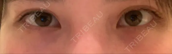 下まぶたの脂肪取り 品川美容外科 仙台院 DAY 13 メイン用