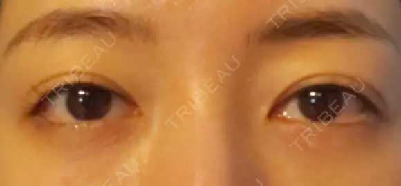 クマ治療 APOLLO BEAUTY CLINIC DAY 16 メイン用