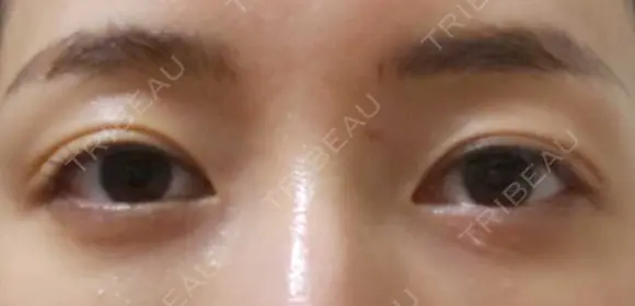 クマ治療 APOLLO BEAUTY CLINIC DAY 18 メイン用