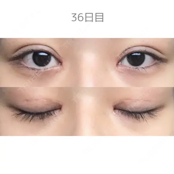 二重切開 / 目頭切開 / 上まぶたたるみ取り サラ美容外科 DAY 36 メイン用