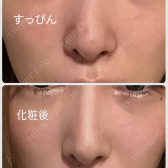 鼻尖形成（切開） 銀座マイアミ美容外科 DAY 21 メイン用